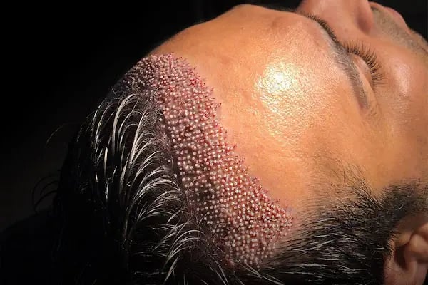 Hairpol | Hair Transplant Clinic (Saç Ekimi Kliniği) - Resim 11