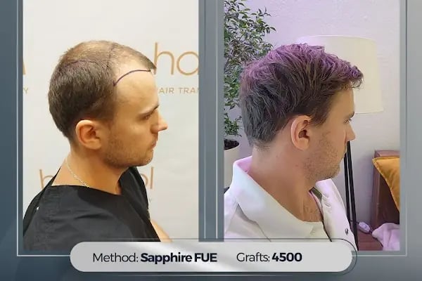 Hairpol | Hair Transplant Clinic (Saç Ekimi Kliniği) - Resim 9