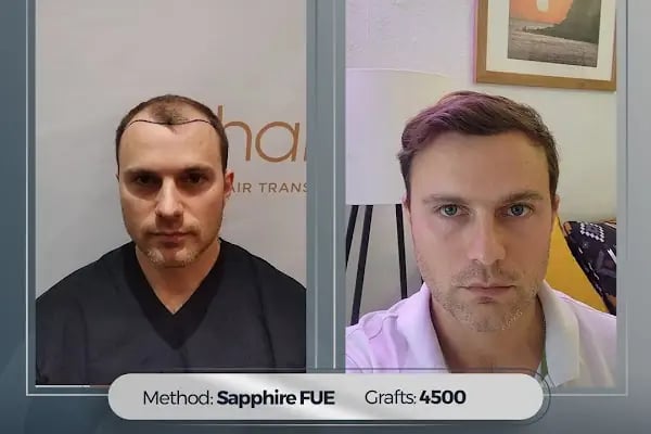 Hairpol | Hair Transplant Clinic (Saç Ekimi Kliniği) - Resim 1