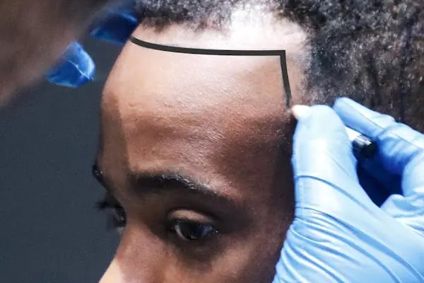 Hairpol | Hair Transplant Clinic (Saç Ekimi Kliniği) - Resim 15