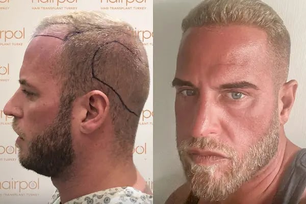 Hairpol | Hair Transplant Clinic (Saç Ekimi Kliniği) - Resim 5