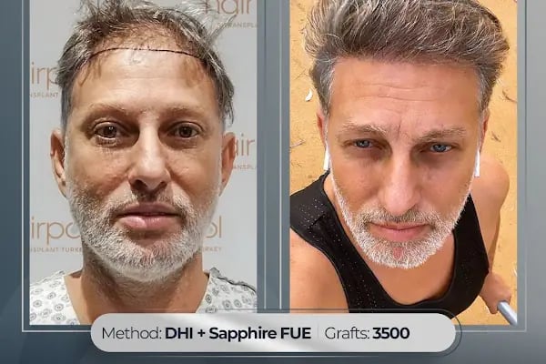 Hairpol | Hair Transplant Clinic (Saç Ekimi Kliniği) - Resim 7