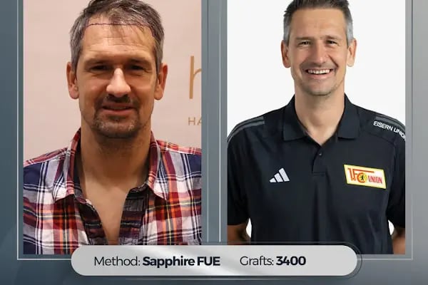 Hairpol | Hair Transplant Clinic (Saç Ekimi Kliniği) - Resim 13