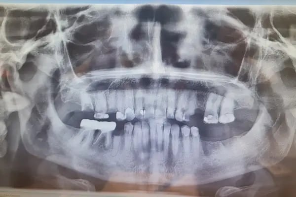 ÖZEL WESTDENT AĞIZ DİŞ HASTANESİ- Türkiye İzmir İmplant Diş Dent Clinic Türkey Dental İmplants in Turkey Zirconium in Turkey - Resim 15