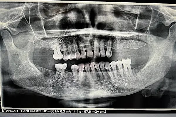 DURU DENT Ağız ve Diş Sağlığı Polikliniği - Resim 10