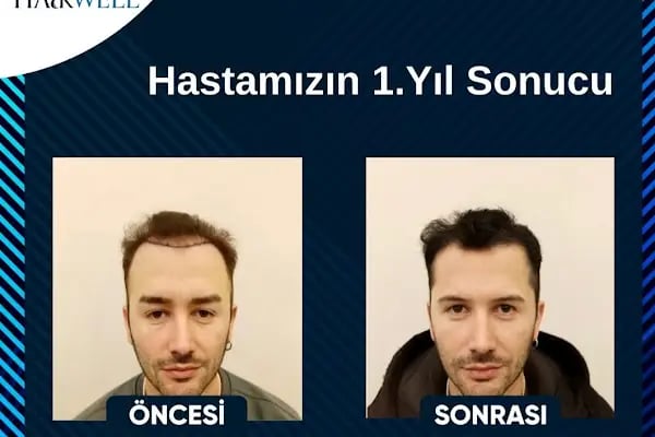 Hairwell Clinic Saç Ekim Merkezi - Resim 2