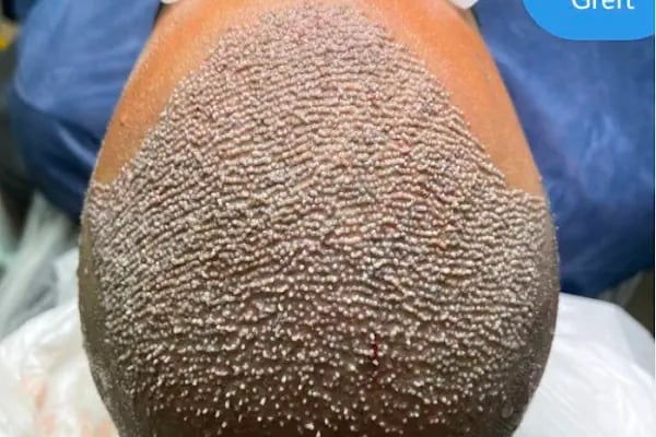 Clinic DHT | Saç Ekim Merkezi | Hair transplant | Dhi Saç Ekim Kliniği - Resim 6