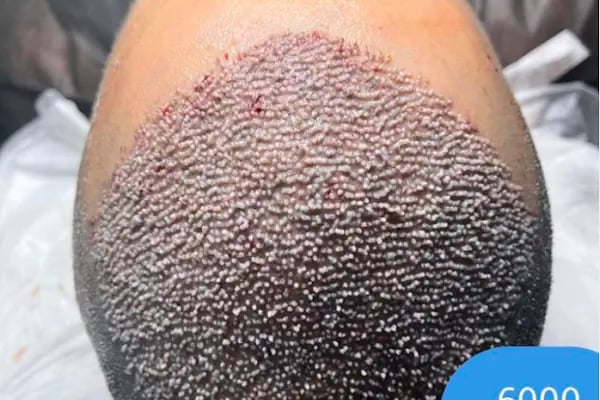 Clinic DHT | Saç Ekim Merkezi | Hair transplant | Dhi Saç Ekim Kliniği - Resim 10