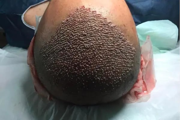 Clinic DHT | Saç Ekim Merkezi | Hair transplant | Dhi Saç Ekim Kliniği - Resim 15