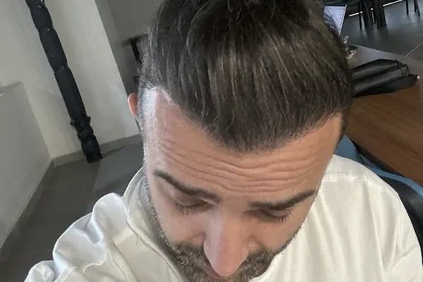 SULTAN ÖZMEN HAIR CLINIC - Resim 6