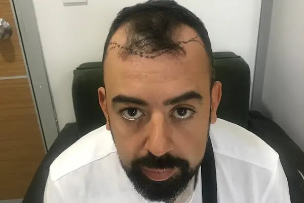 SULTAN ÖZMEN HAIR CLINIC - Resim 4