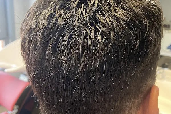 Protez Saç Ankara (Hairlife) - Resim 13
