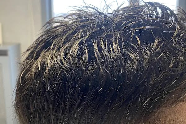 Protez Saç Ankara (Hairlife) - Resim 14