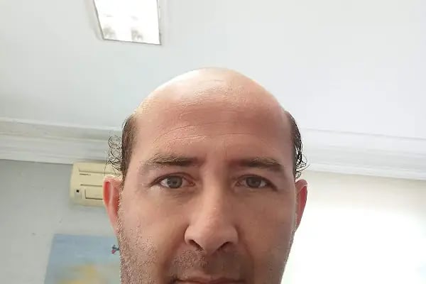 Protez Saç Ankara (Hairlife) - Resim 11