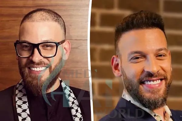 UĞUR YAVUZ CLİNİC SAÇ EKİMİ ( hair transplant ) - Resim 18