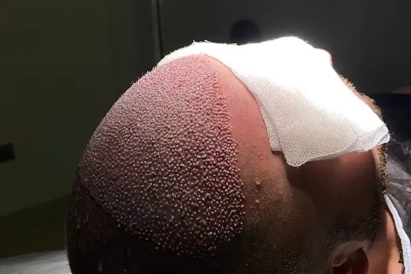 UĞUR YAVUZ CLİNİC SAÇ EKİMİ ( hair transplant ) - Resim 13