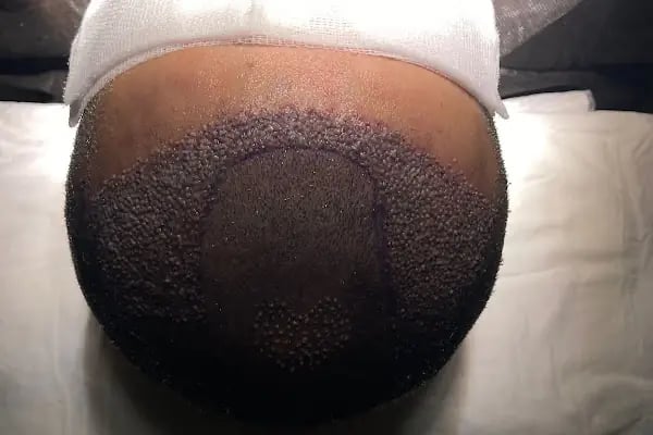 UĞUR YAVUZ CLİNİC SAÇ EKİMİ ( hair transplant ) - Resim 15