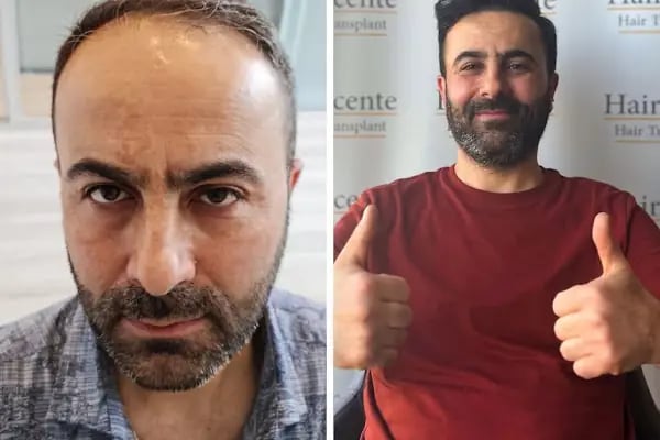 Ankara Saç Ekim Merkezi (Haircente Clinic) - Resim 14