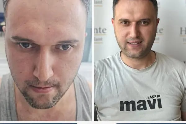 Ankara Saç Ekim Merkezi (Haircente Clinic) - Resim 9