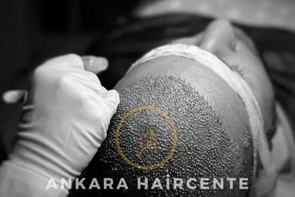 Ankara Saç Ekim Merkezi (Haircente Clinic) - Resim 7