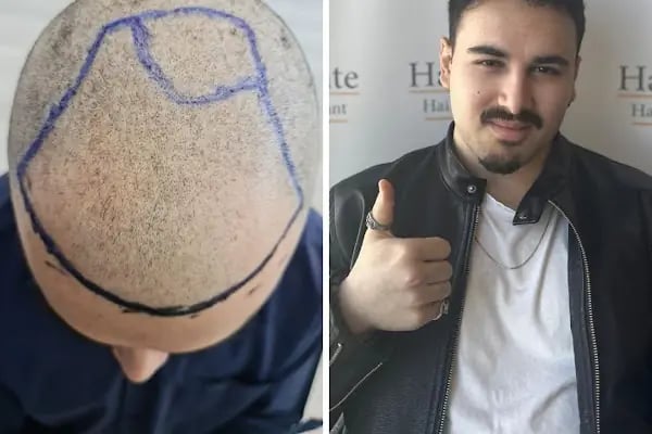 Ankara Saç Ekim Merkezi (Haircente Clinic) - Resim 12