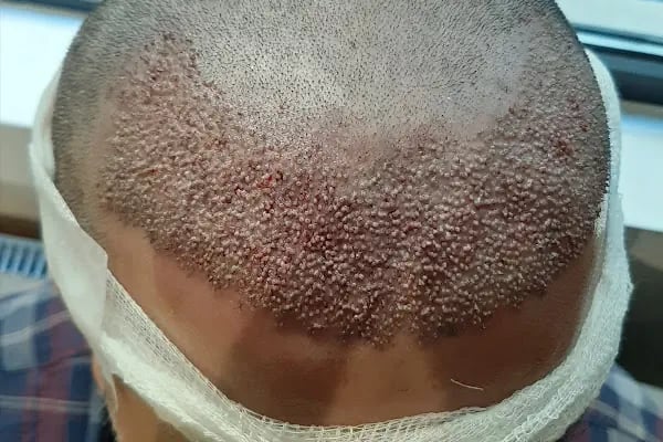 Ankara Saç Ekim Merkezi (Haircente Clinic) - Resim 15