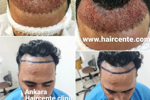 Ankara Saç Ekim Merkezi (Haircente Clinic) - Resim 1