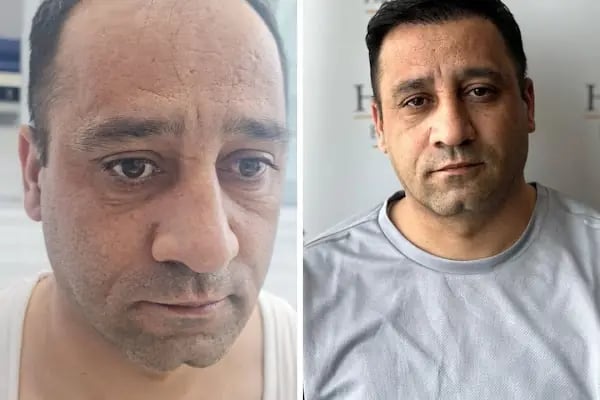 Ankara Saç Ekim Merkezi (Haircente Clinic) - Resim 5