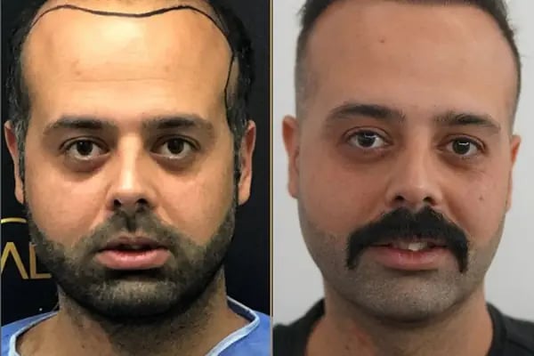 Hair Transplant Of Antalya / Antalya Saç Ekimi / Altınsoy Hair Clinic - Resim 11
