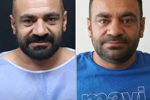 Hair Transplant Of Antalya / Antalya Saç Ekimi / Altınsoy Hair Clinic - Resim 3