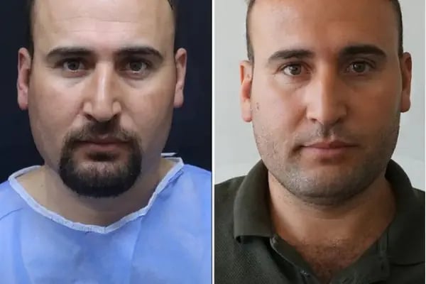 Hair Transplant Of Antalya / Antalya Saç Ekimi / Altınsoy Hair Clinic - Resim 9