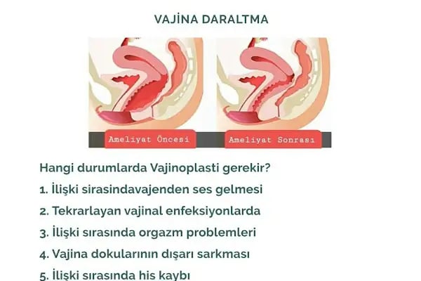 Dr. Bülent Arıcı / Labioplasti - Vajinoplasti - Himenoplasti - Resim 4