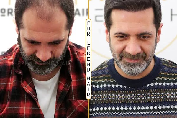 For Legend Hair Transplant - Resim 19