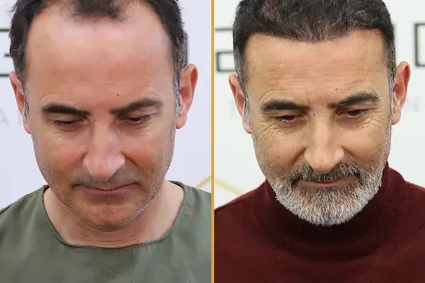 For Legend Hair Transplant - Resim 1