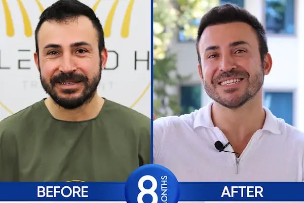 For Legend Hair Transplant - Resim 14