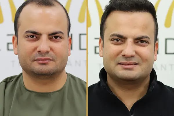 For Legend Hair Transplant - Resim 12