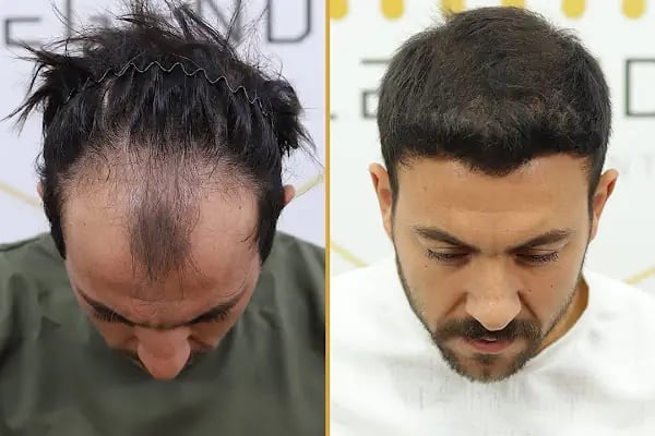 For Legend Hair Transplant - Resim 15