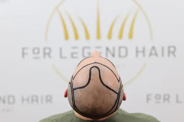 For Legend Hair Transplant - Resim 18