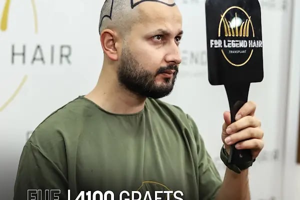 For Legend Hair Transplant - Resim 2