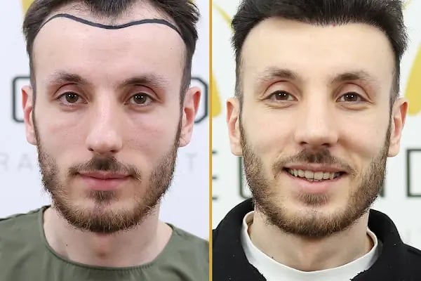 For Legend Hair Transplant - Resim 8