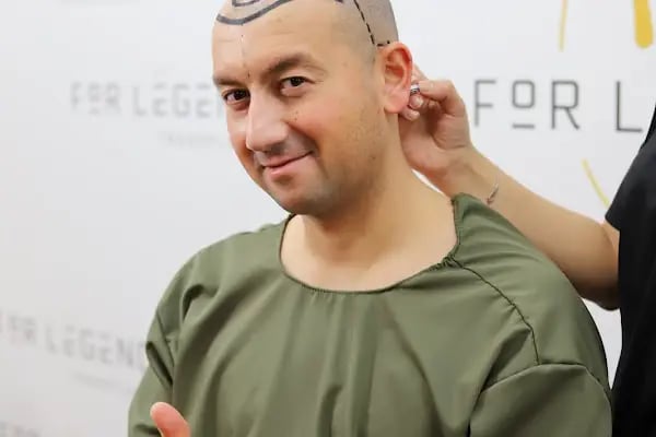 For Legend Hair Transplant - Resim 20