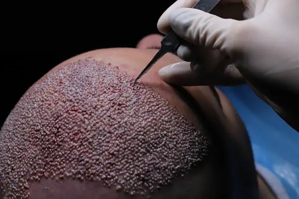 For Legend Hair Transplant - Resim 17