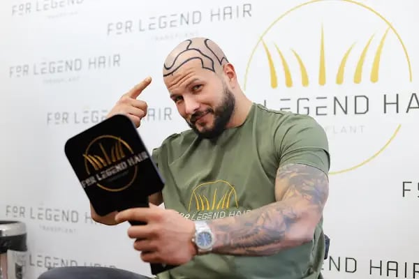 For Legend Hair Transplant - Resim 16