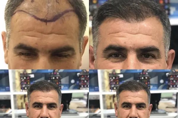Van Lokman Hekim Hayat Hastanesi - Saç Ekim Birimi - Resim 3