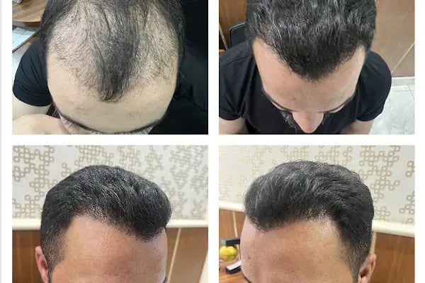Van Lokman Hekim Hayat Hastanesi - Saç Ekim Birimi - Resim 5