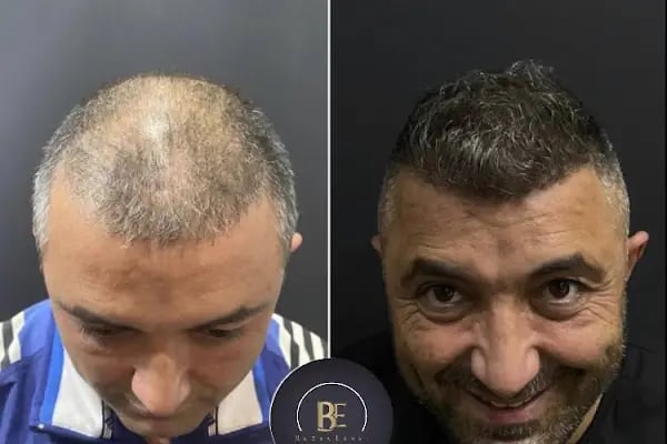 Saç Ekim Merkezi | Buğra Erdal ® Hastane Saç Ekimi | Ankara Saç Ekimi PRP Mezoterapi - Resim 17