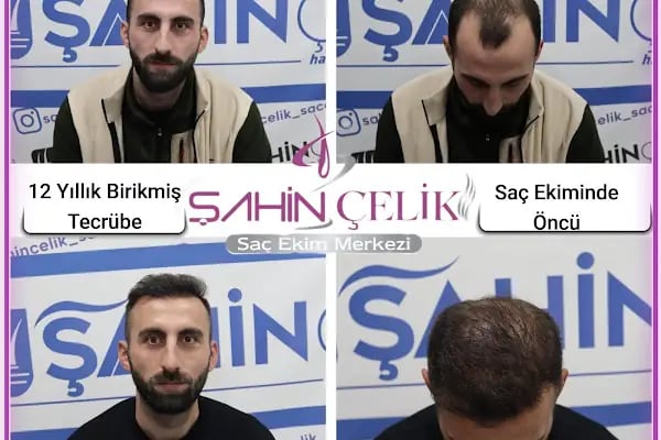 LifeHair Ankara | Saç Ekimi Ankara | Şahin Çelik | Ankara Saç Ekim Merkezi - Resim 1