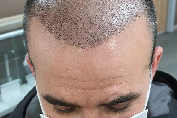 Mir Hair Clinic - Resim 5