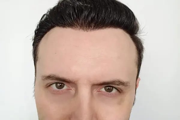 Mir Hair Clinic - Resim 8