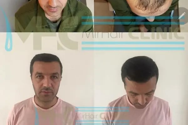 Mir Hair Clinic - Resim 11